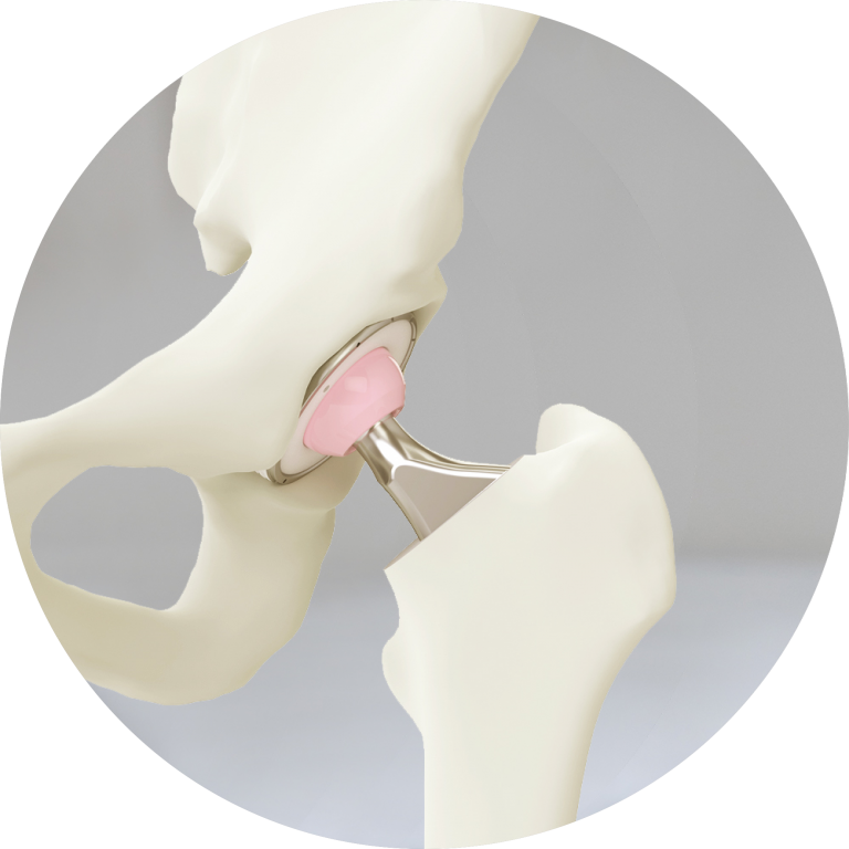 Hip Fracture Central Coast Dr Simon Hutabarat