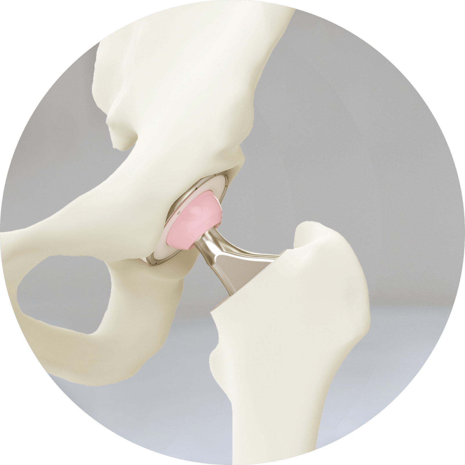 What is a Total Hip Replacement? - Brisbane Physiotherapy