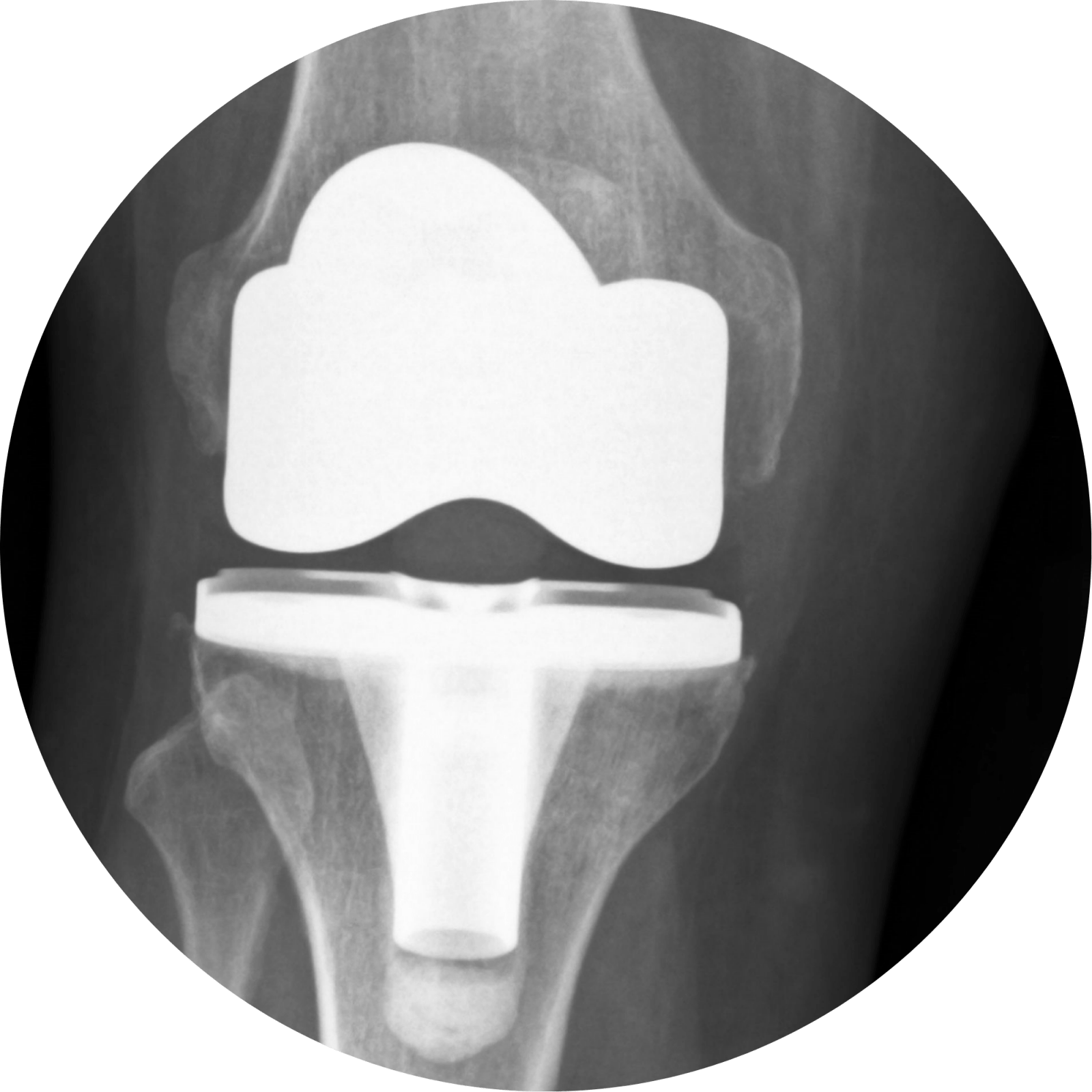 1474Knee Replacement Surgery