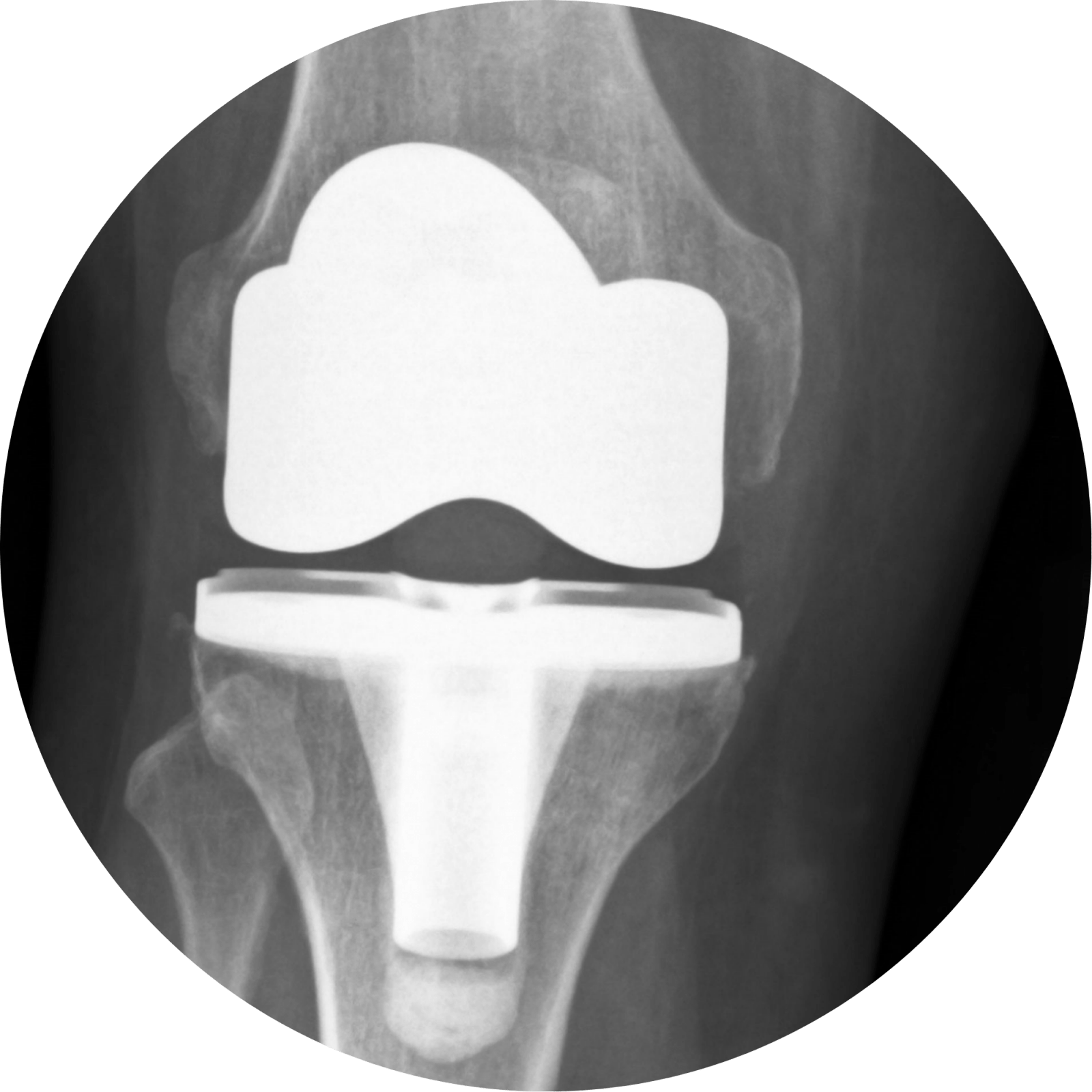 knee-replacement-surgery-central-coast-dr-simon-hutabarat